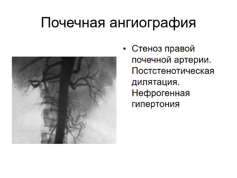 Почечная ангиография Стеноз правой почечной артерии. Постстенотическая дилятация. Нефрогенная гипертония